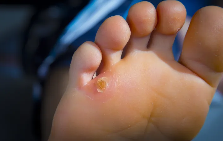 Top 10 Best Foot Callus Remover Reviews 3 foot callus remover