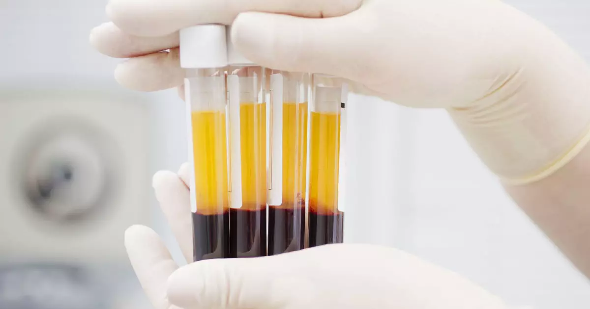 PRP Centrifuge – A Game Changer In Pain Management  5 PRP Centrifuge