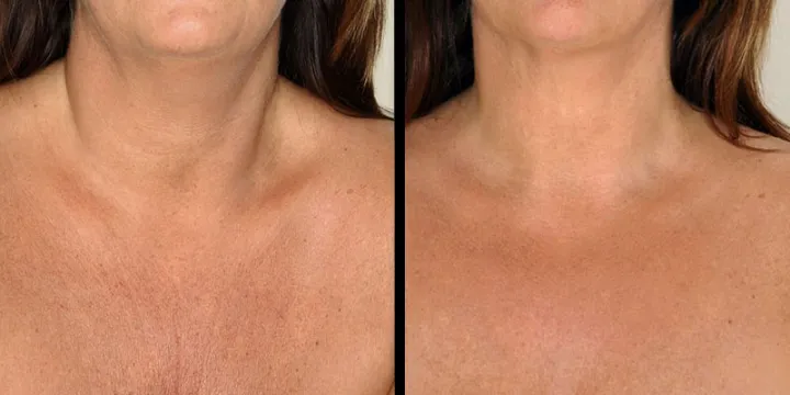 Best Derma Roller For Neck: The Secret To Glowing And Youthful Skin 36 Derma Roller For Neck