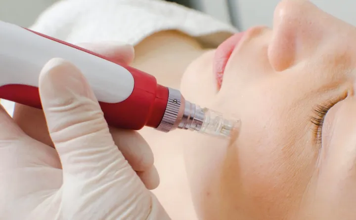 Experience Unbelievable Youthful Skin With Hyaluron Pen Treatment! 38 Hyaluron Pen Treatment