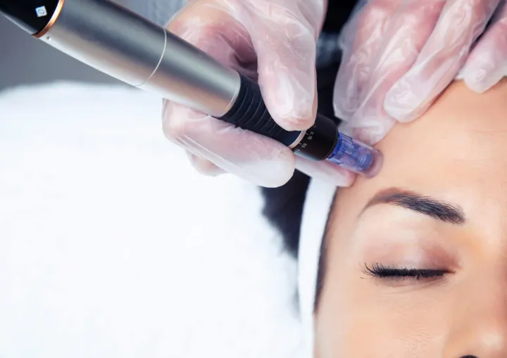 Experience Unbelievable Youthful Skin With Hyaluron Pen Treatment! 37 Hyaluron Pen Treatment