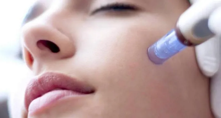 Experience Unbelievable Youthful Skin With Hyaluron Pen Treatment! 39 Hyaluron Pen Treatment