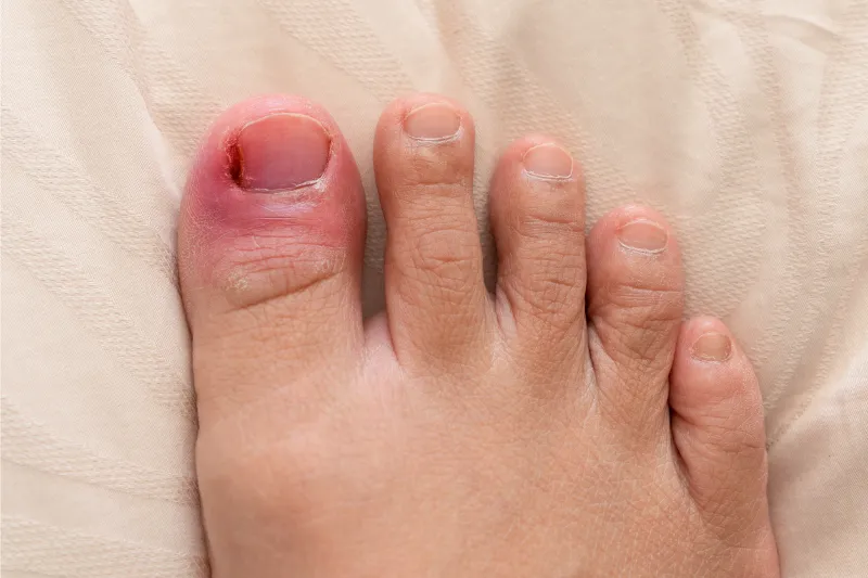 How To Fix Ingrown Toenail 3 24
