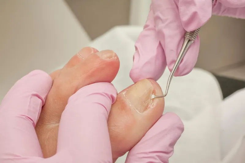 How To Fix Ingrown Toenail 2 fix ingrown toenail