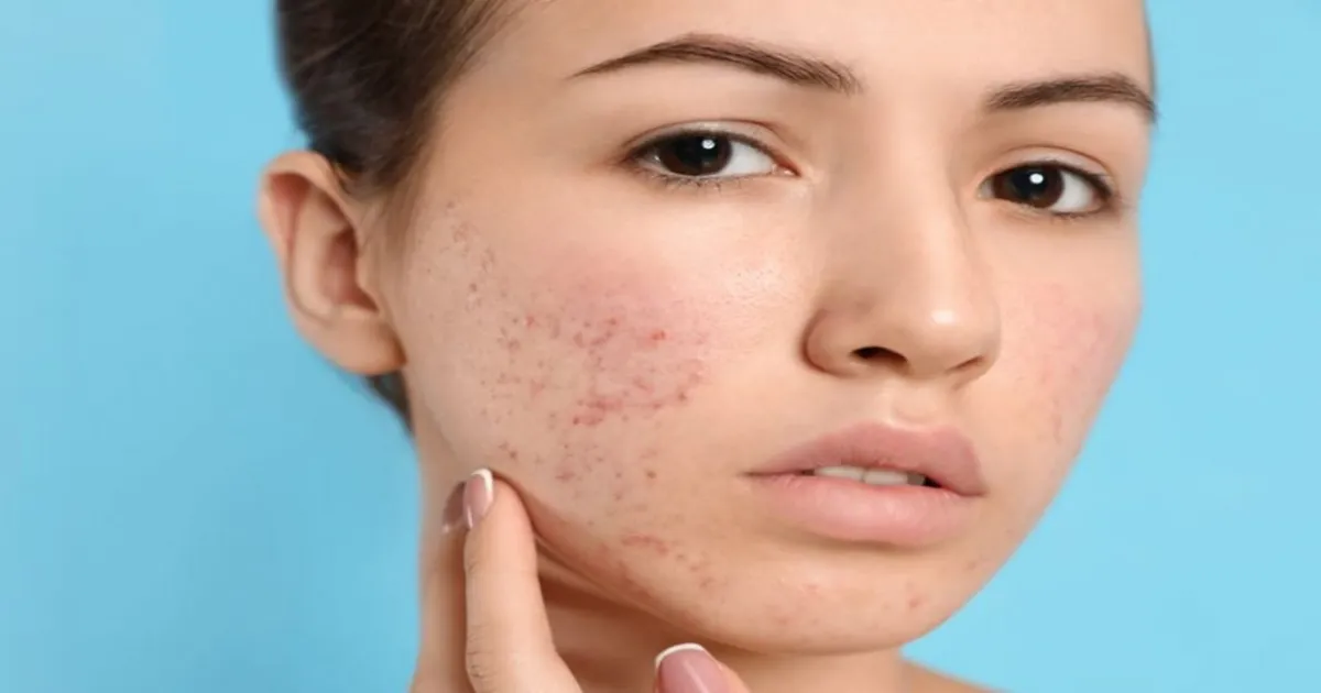 How to Best Treat Acne Scars