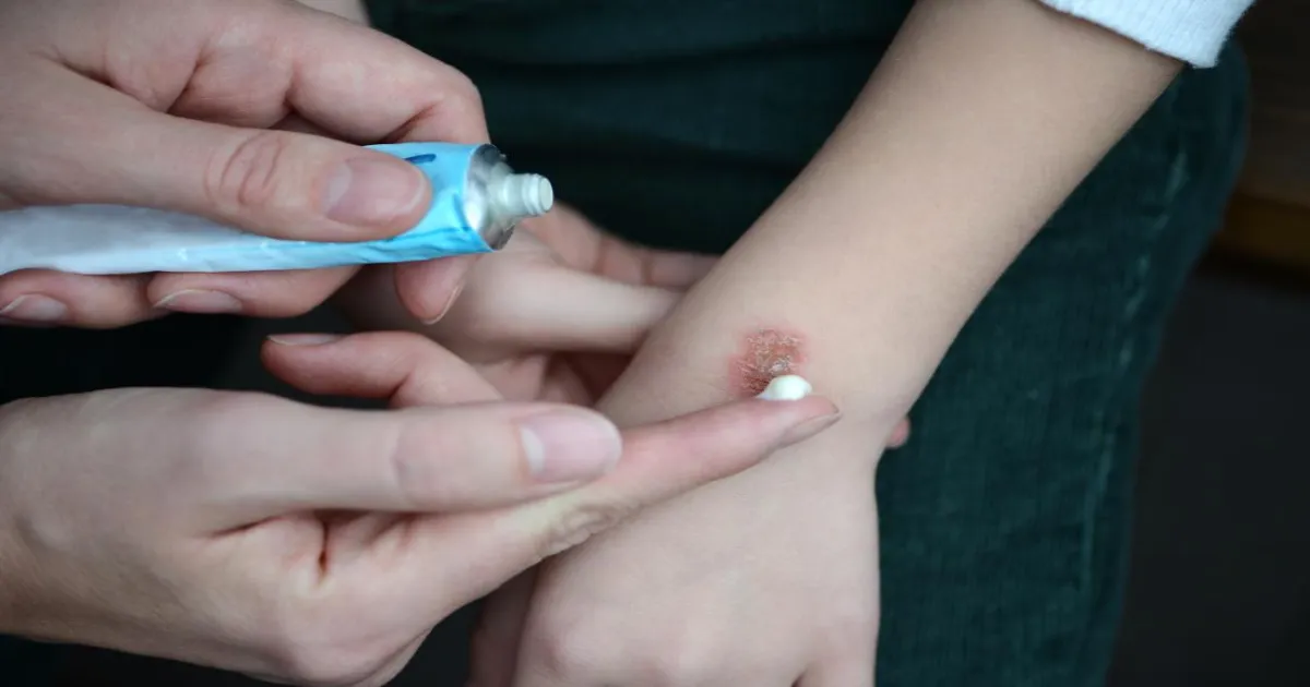 How to Best Treat Burn Scars