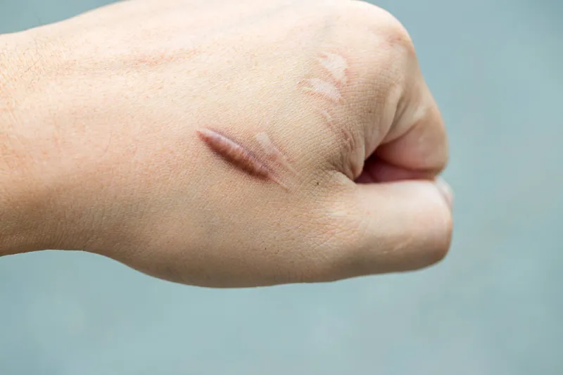 How To Best Treat Keloid Scars Successfully 3 How to Best Treat Keloid Scars Successfully