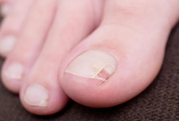 How To Fix A Cracked Toenail 2 fix cracked toenail