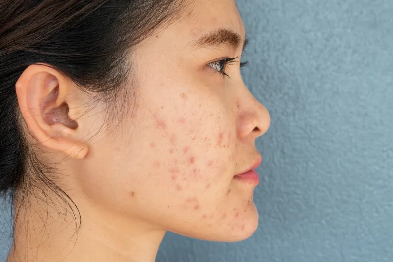 How To Best Treat Acne Scars 3 How to Best Treat Acne Scars