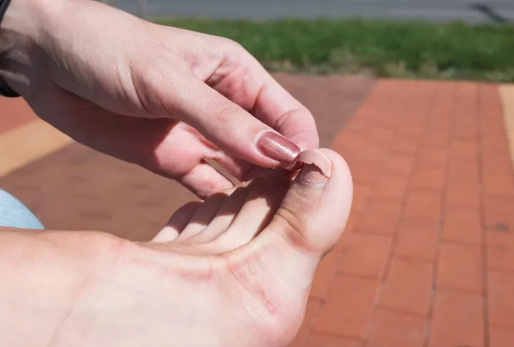 How To Fix A Cracked Toenail 3 fix cracked toenail