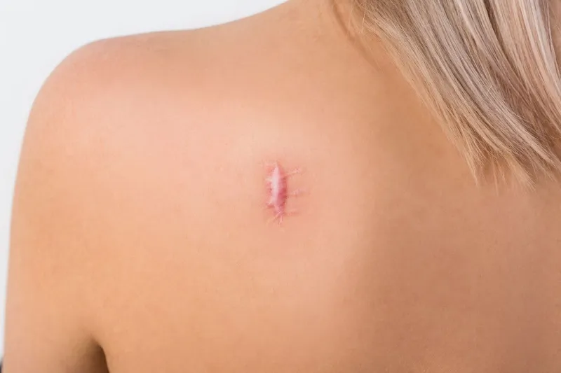 How To Best Treat Keloid Scars Successfully 2 How to Best Treat Keloid Scars Successfully