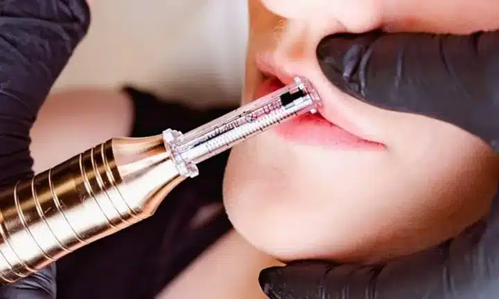 A Comprehensive Review Of Hyaluronic Acid Pen Fillers 47 H Pen 1000x 1