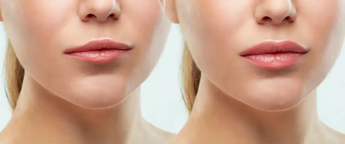A Comprehensive Review Of Hyaluronic Acid Pen Fillers 10 hyaluronic acid pen fillers