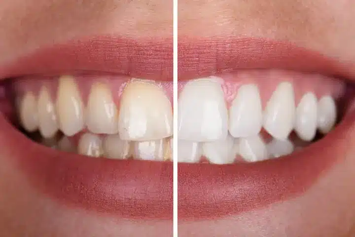 What To Look For In Home Best Teeth Whitening Kits 3 what to look for in home best teeth whitening kits